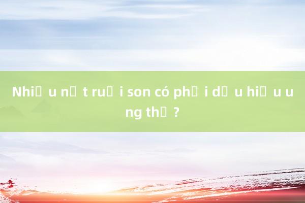 Nhiều nốt ruồi son có phải dấu hiệu ung thư?